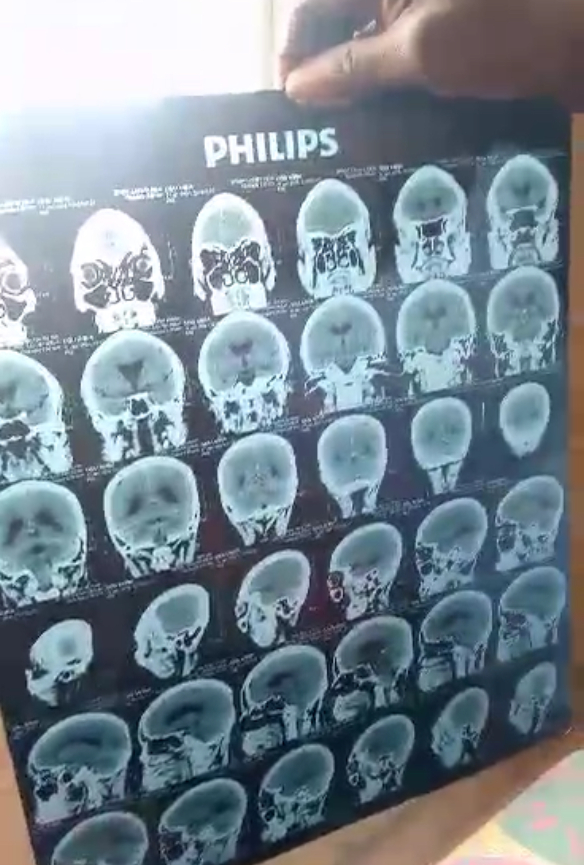 IMG_6025 Brain MRI