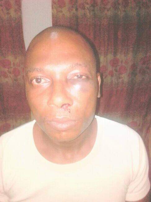 received_290833596163406 Had a swelling which aggravated the cataract. The doctors say I need the surgery A S.A.P